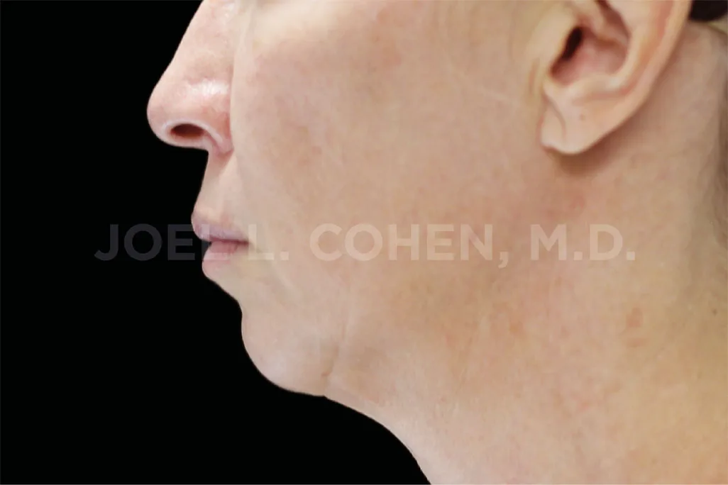 EMface facial toning Dublin - before photo of the jawline and neck in profile Jawline and neck in profile before EMface facial toning at our Dublin clinic